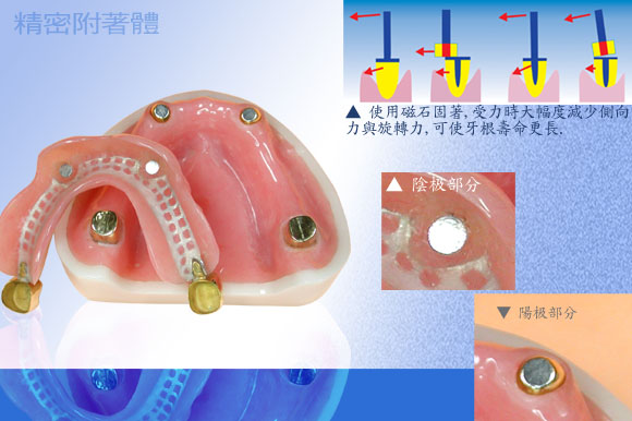 磁鐵式精密附件